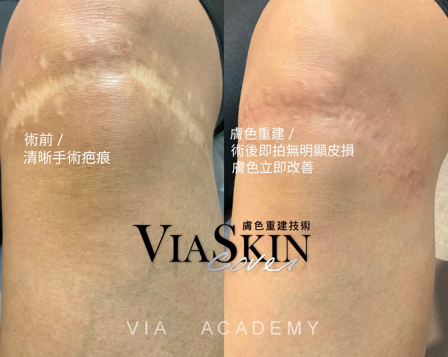【 手術疤痕膚色重建 】困擾了10幾年的膝蓋手術疤痕，夏天也不能放心的穿著短褲短裙，